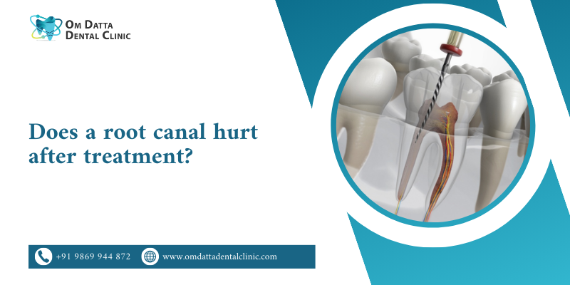Does a Root Canal Hurt After Treatment?