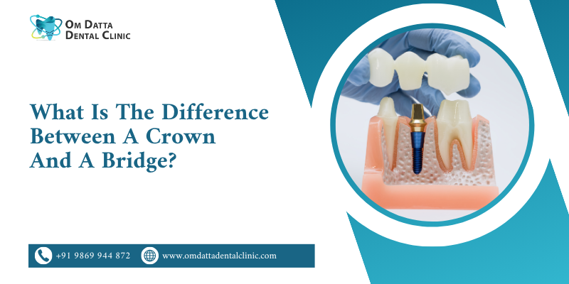 What Is the Difference Between a Crown and a Bridge?